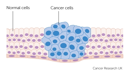 cancer cells growing
